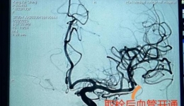 【大醫(yī)精誠在湖一】八旬老人突發(fā)急性缺血性腦卒中，醫(yī)院上演“生命接力”