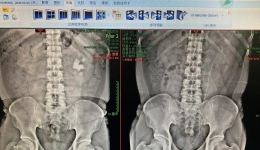 【卓越醫(yī)療在湖一】 腎鑄型結(jié)石不用怕，無創(chuàng)碎石取石技術(shù)還您腎健康